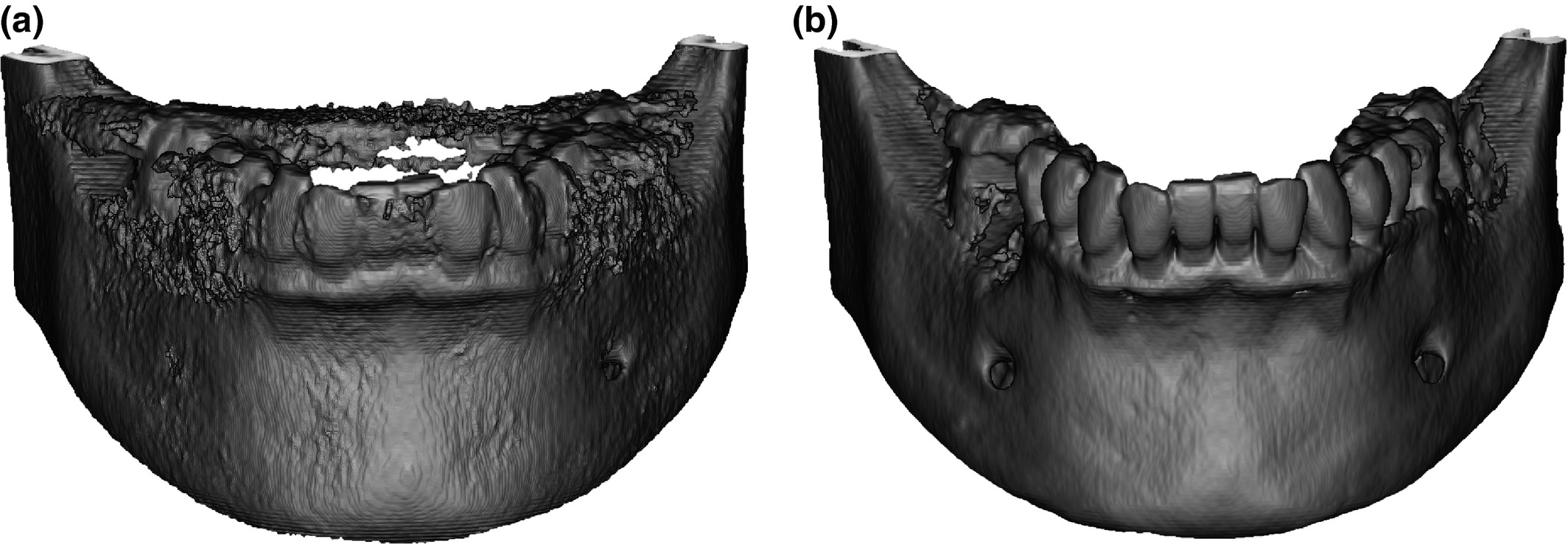 CBCT showing metallic artefact around dental restorations